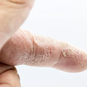 Skin tightening treatment close-up