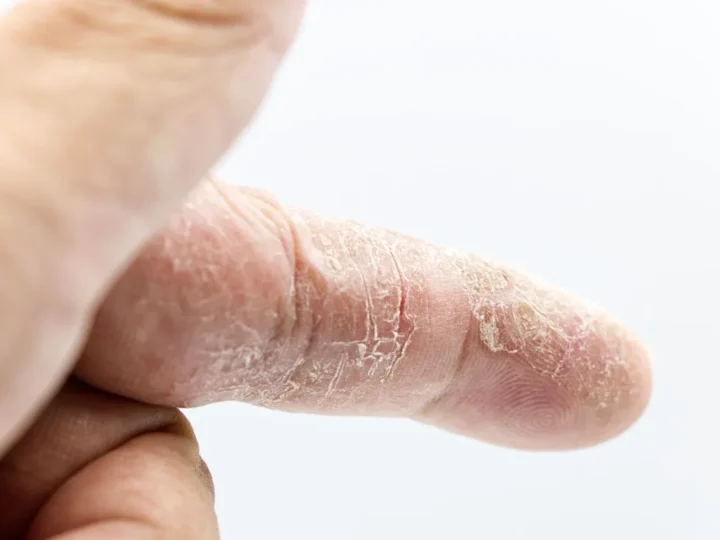 Skin tightening treatment close-up
